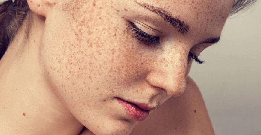 Sol y Manchas en la Piel